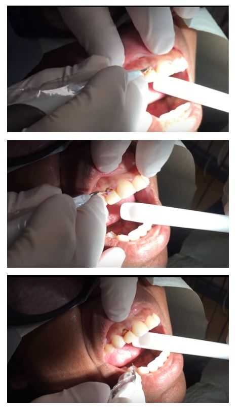 dental laser with porcelain veneers, cosmetic laser dentistry, laser gingivectomy, laser dentist