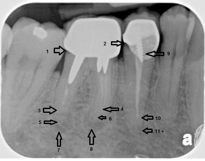 root canal tooth pain x-ray 