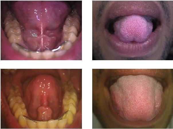 tongue-tied treatment surgery, frenulectomy