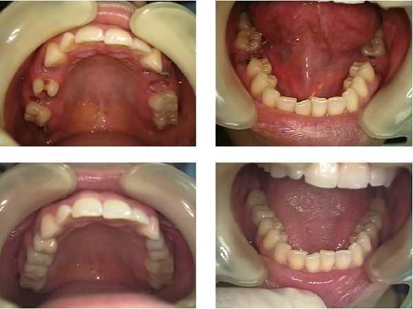 Single tooth dental implant