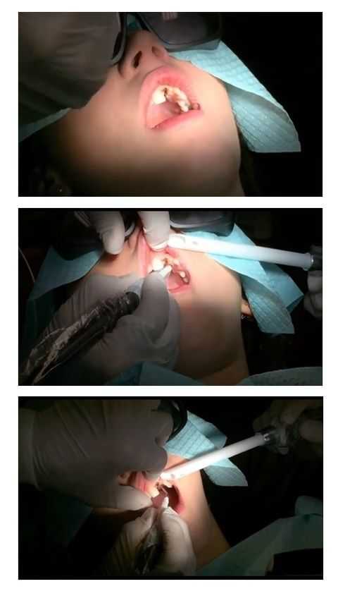 dental laser with dental implants, uncover dental implant with a laser, laser dentistry, laser denti