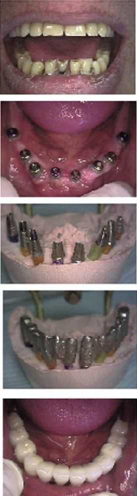 Full mouth dental implants before and after photos