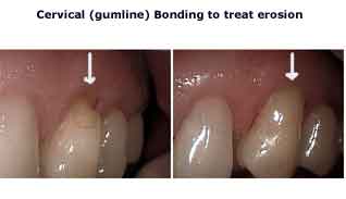 abfraction toothbrush erosion class 5 five V tooth lesion cervical gum line teeth bonding abrasion