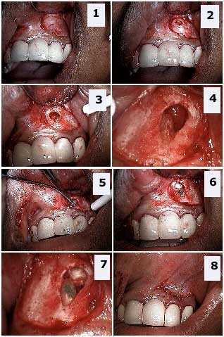 apicoectomy, root canal apical gum oral surgery, cortical bone, Retrograde Filling, root apex