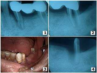 removal of porcelain dental bridge drilling cutting crown cap sectioning, Bone Loss, periodontal
