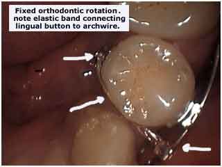 Accelerated invisible fastest braces using elastics rotation rotators by a top New York orthodontist.