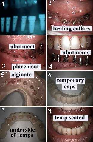 acrylic temporary Caps plastic dental Bridges, edentulous, osseointegration dental implants