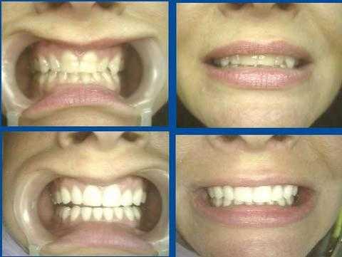 Aesthetic dentistry dentist Porcelain veneers laminates before and after photos pictures Dr. Dorfman