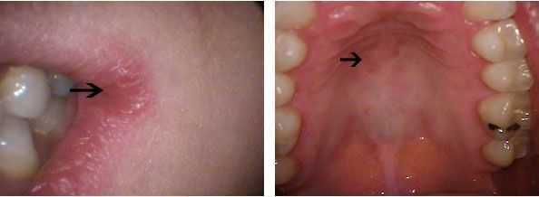 diagnosis angular cheilitis palatal stomatitis candida albicans yeast oral mouth symptoms