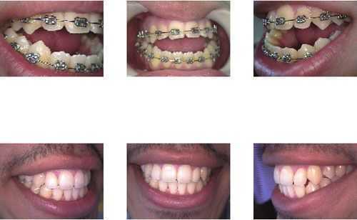 anterior open bite orthognathic surgery oral orthodontics braces pictures closure