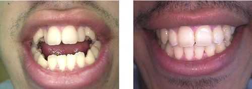 anterior open bite orthognathic surgery oral orthodontics braces space closure