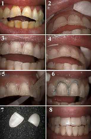 In-office teeth bleaching in office laser tooth whitening or professional teeth whitening plus porcelain veneers.