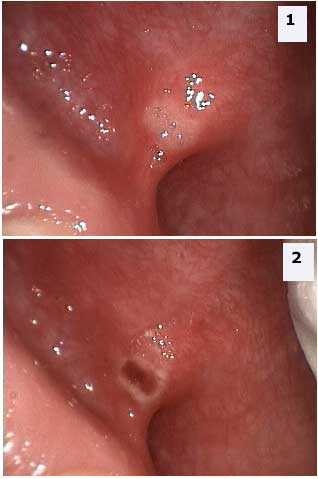 Aphthous Ulcer, Canker Sore, Diagnosis Dentistry, dental symptoms treatment intraoral clinical exam