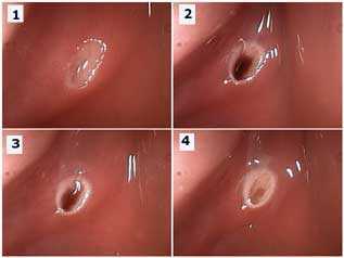 Aphthous Ulcer, Canker Sore Pain, intraoral clinical examination, evaluation symptoms