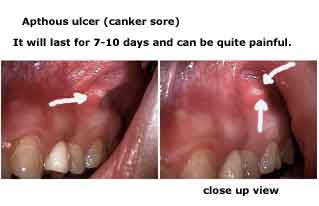 Aphthous Ulcers canker sores treatment mouth sores oral lesions apthous pathology medicine