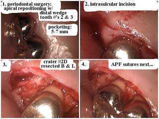 apical repositioning periodontal gum surgery, apically repositioned flap gums treatment