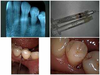 porphyromonas gingivalis, actinobacillus actinomycetemcomitans, atridox, doxycycline, antibiotics