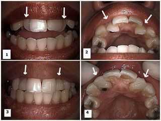 Herculite XRV dental bonding material, Crowding crowded crooked cosmetic dentistry sculpting