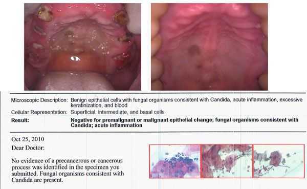 Benign epithelial cells with fungal organisms with Candida in palate, oral yeast infection, melanin