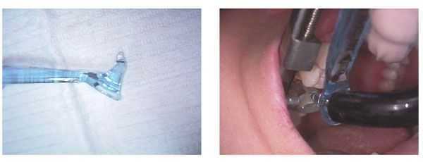 CEJ Dental Contact Pro, how interproximal contacts, instruments, armamentarium, matrix band, teeth 