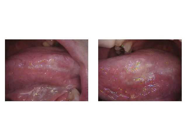 Bilateral leukoplakia hyperkeratosis  tongue thrust habit geographic tongue  oral pathology symptoms