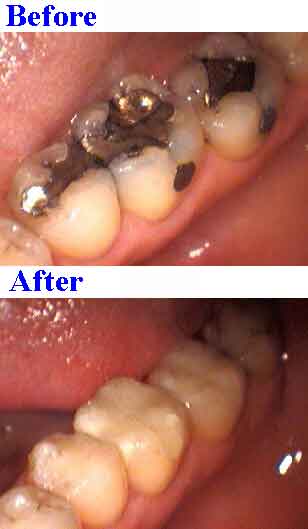 bonded dental, bonded cosmetic dentistry silver filling removal, remove tooth fillings mercury