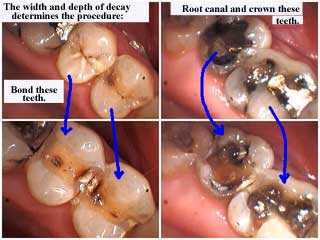 Compare bonding and crowns, Bonded dental bonding filling rationale, reason for tooth crown cap, 