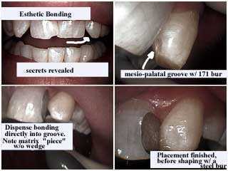 bonding for crowding, cosmetic bonding, bonding to close space, method how to technique explain