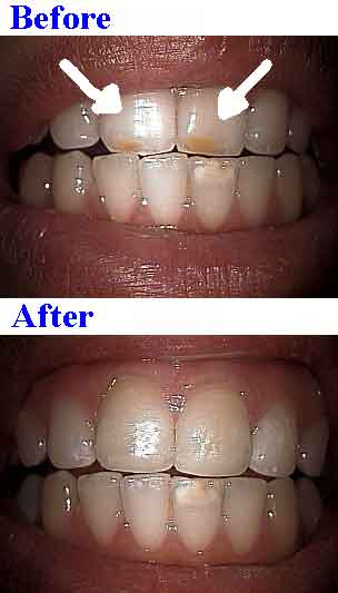 bonding for intrinsic stains color stained fillings yellow gray grey composites treatment time