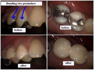 bonding smile, removal of fillings, bonding bonded restorations, composite resin tooth fillings