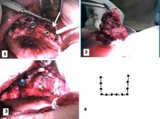 bone evaluation jawbone, alveolar ridge, cortical plate, sinus elevation, bone graft, platelet-rich