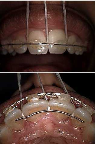 braces, fixed orthodontic retention dental palatal wire bonded retainer teeth procedure
