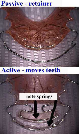 hawley tooth retainers, spring aligner,  orthodontics active passive appliances  removable braces