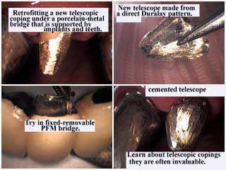 telescopes, telescopic copings, implant prosthodontics complications, crown porcelain dental bridge