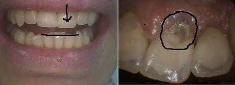 dental crown fracture Moscow Russian front tooth etiology preventing teeth supraeruption problems