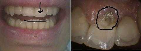 Supraeruption tooth teeth hypereruption supra-eruption crown fracture hypermobility