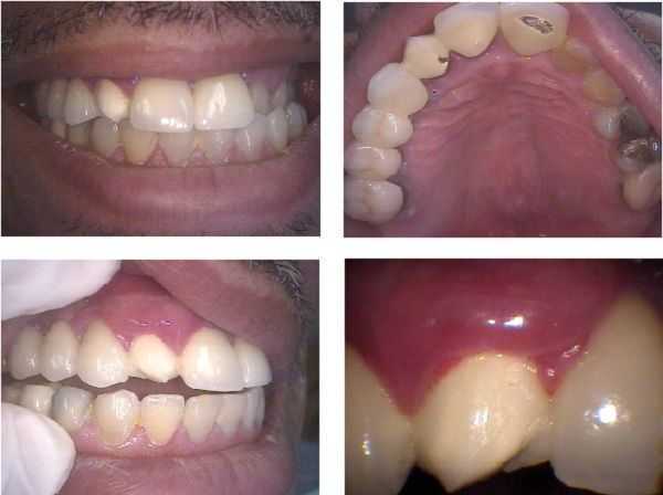 broken porcelain fracture dental bridge crown repair, complications, problems