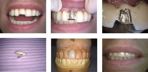broken porcelain teeth dental tooth crown bridge metal repair fix problems cap complications broke