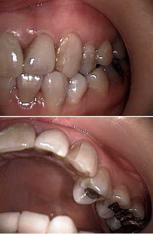 porcelain teeth veneers dental laminates tooth edge to edge occlusion bite broken fracture how to