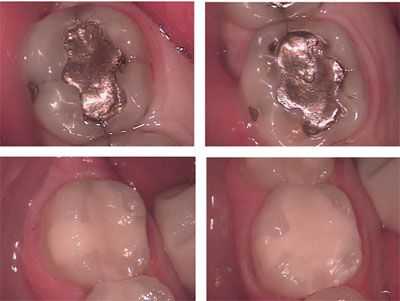 broken silver filling, cavity, tooth decay, dental bonding, white filling, carious lesion