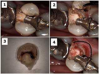 Tooth Fracture amalgam silver dental filling Decay teeth cavity fractured broken cusp oral mouth