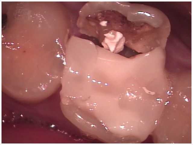 Broken Tooth Teeth chipped cracked fracture broke chips cracks fractured dental filling break