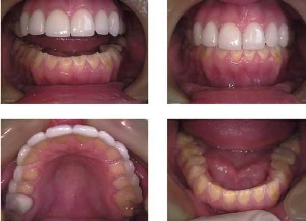 Bulimia anorexia, dental erosion, teeth damage, porcelain veneers