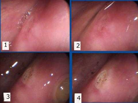 Medication in dentistry, canker sore pain   aphthous ulcer oral pain mouth how to pictures diagnosis