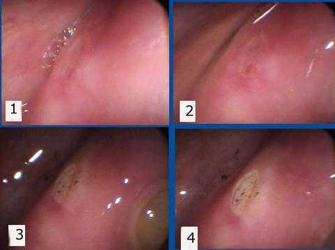 canker sore, aphthous ulcer,
oral pathology, medicine, diagnosis 
symptoms treatment disease cure 