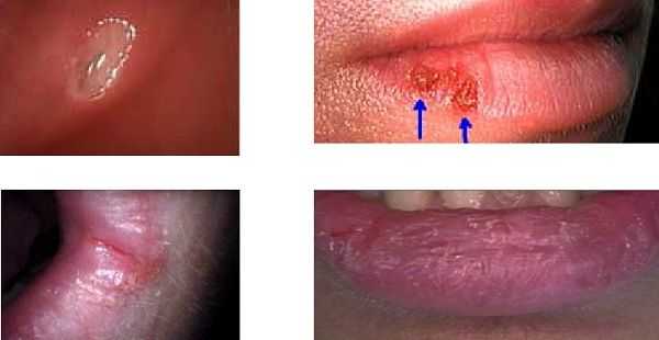 canker sore, herpes, fever blister, cold sore, angular cheilitis, chapped lips, comparison, aphthous