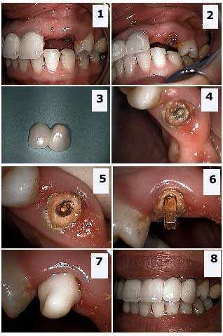 dental crown buildup bonding composite resin core Cantilevered teeth bridge failed failure post pre