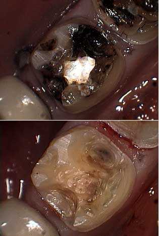 tooth decay crown cavity recurrent dental caries preparation how to crown cap root canal teeth technique