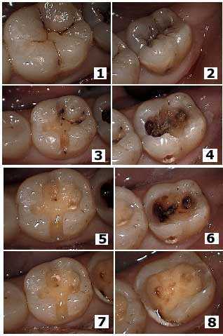 How to diagnose Cavity, Decay, Detection, Cavity Preparation, Removal of Tooth Decay, composite