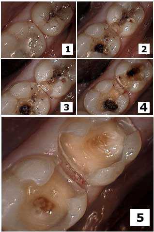 Cavity identification Decay diagnosis Interproximal Crack teeth tooth Decalcification